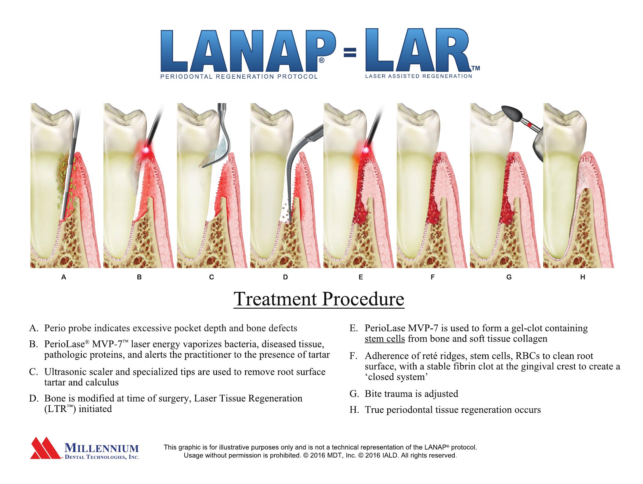 LANAP® treatment procedure shown in eight steps, A through H: periodontal probing of the diseased pocket, laser removal of bacteria and diseased tissue, ultrasonic removal of root tartar, bone modification, laser-formed gel clot containing stem cells, a sealed closed system, bite adjustment, and true periodontal tissue regeneration