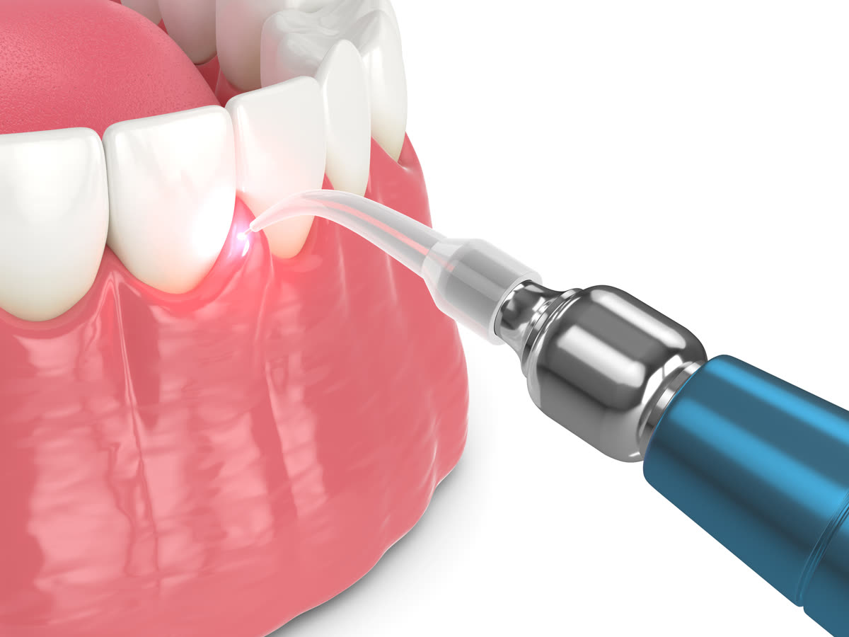 Laser Pocket Disinfection during a routine cleaning at Regency Dental Care in Palatine, IL