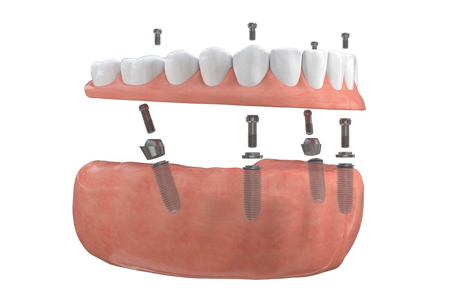Full-arch implant-supported bridge at Regency Dental Care