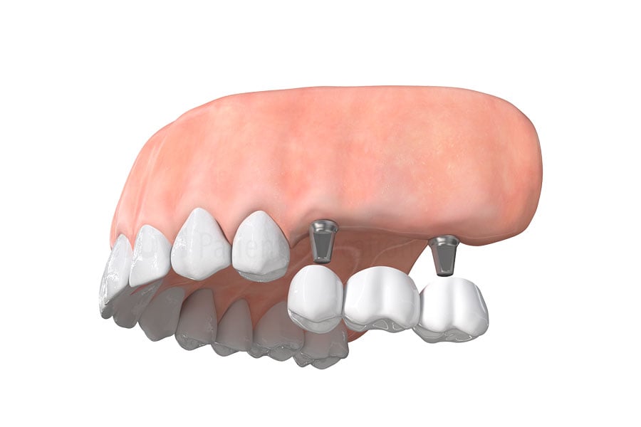 Implant-supported dental bridge at Regency Dental Care