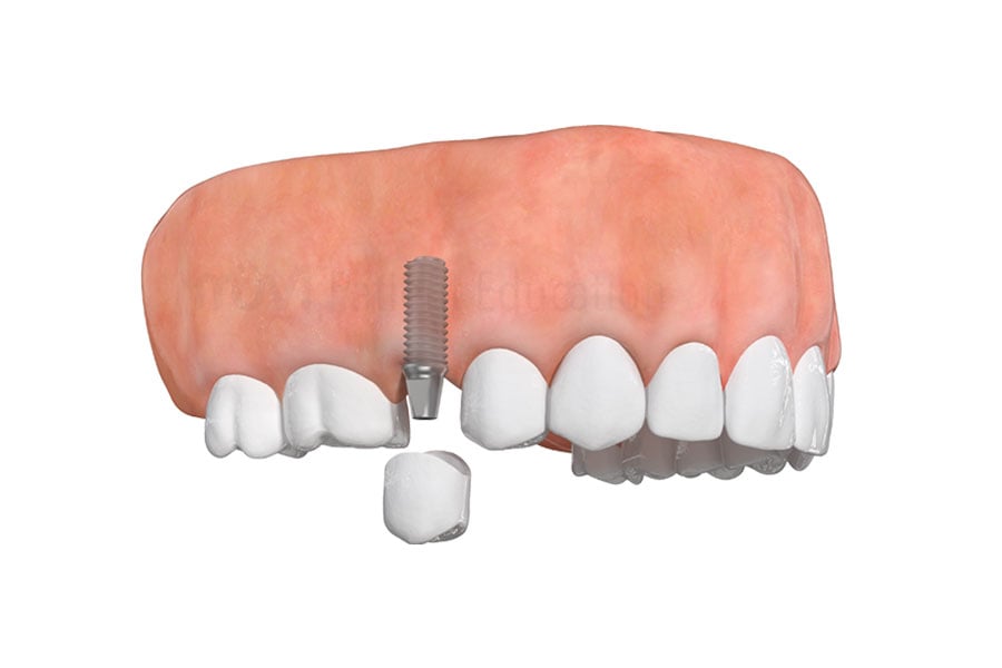 Single dental implant at Regency Dental Care