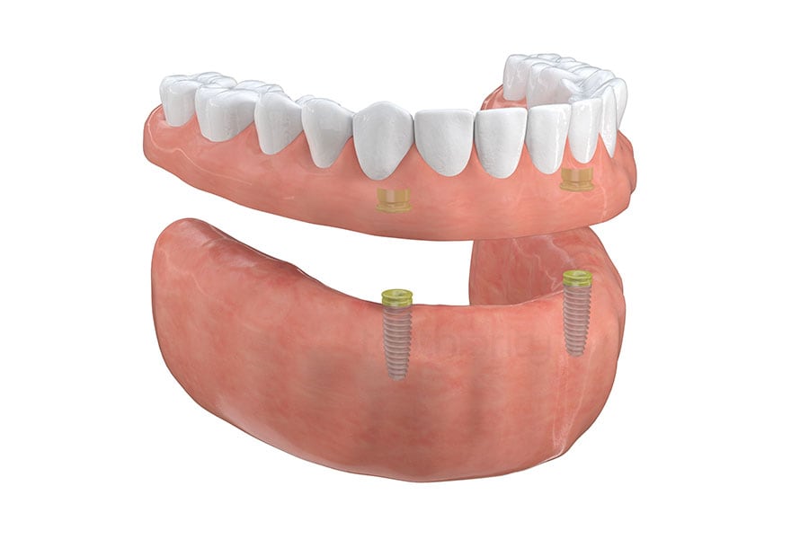 Implant-supported overdenture at Regency Dental Care
