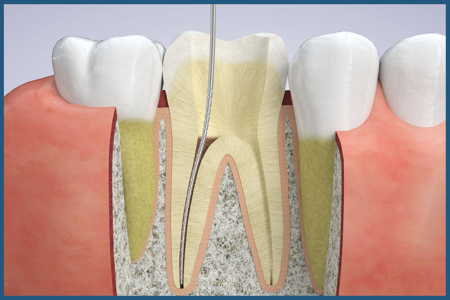 Stages of root canal therapy at Regency Dental Care in Palatine, IL